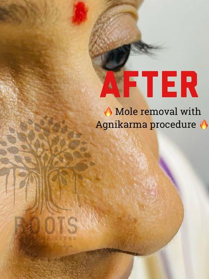 This final "after" shot shows the result of the Agnikarma procedure. There is no scar, no hyperpigmentation, and no wound, just clear skin.