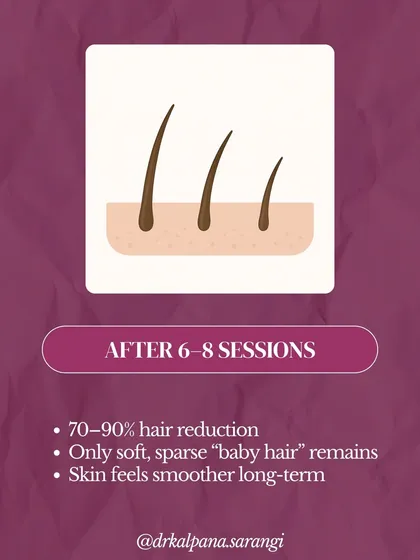 This graphic illustrates the typical outcome after a full course of 6 to 8 laser hair removal sessions. My patients can expect a 70 to 90 percent permanent reduction in hair. Any hair that does regrow is usually much finer and softer, leading to long-term smooth skin.