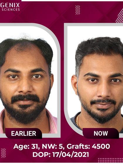 This 31-year-old patient's journey from Grade 5 hair loss to happiness with 4500 grafts.