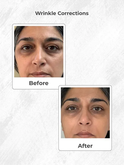 This is a real result from one of my patients. We focused on reducing under-eye wrinkles and fine lines for a fresher, more rested appearance. My goal is always to provide natural-looking anti-aging results that restore your confidence.