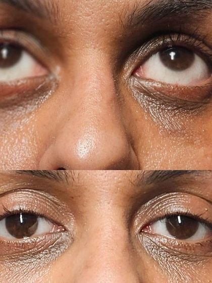 Looking up, you can clearly see the reduction in the deep, shadowy hollows under the eyes after the treatment.