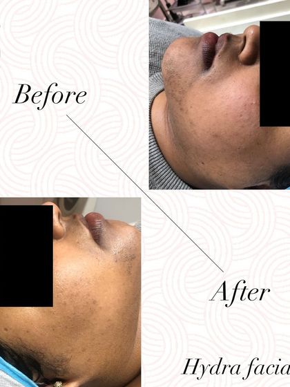 A clear before and after demonstrating how a HydraFacial can hydrate, brighten, and clear the complexion in just one sitting.