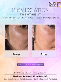 Skin Tone & Pigmentation Correction
