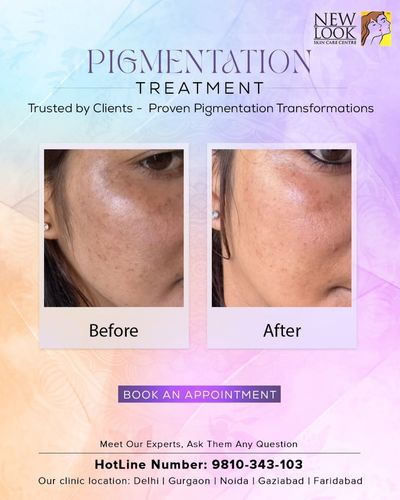 Skin Tone & Pigmentation Correction