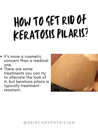 While there is no cure for this harmless genetic condition, there are effective treatments to manage its appearance and improve skin texture.