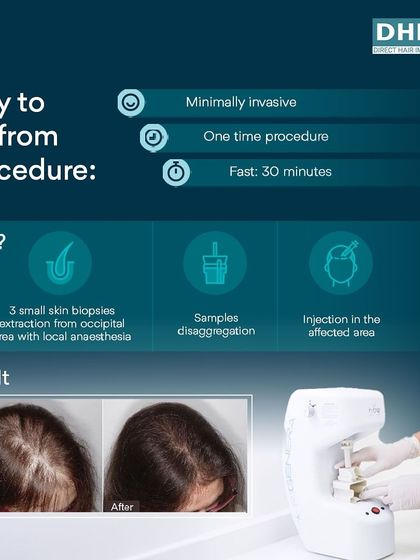 **The Regenera Activa Process:** This graphic illustrates the simple, three-step Regenera Activa procedure. It involves extracting small skin biopsies, processing the samples to isolate regenerative cells, and injecting them into the scalp for a fast, one-time treatment.