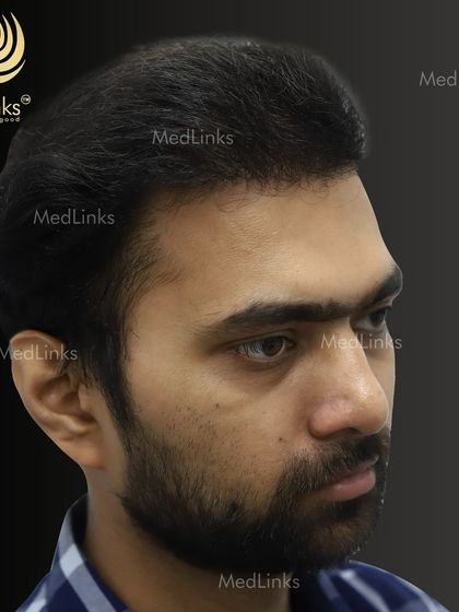 The final result from the side, showing a natural and dense hairline.