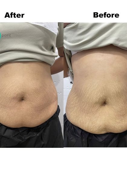 This before and after demonstrates the results of our body contouring and skin tightening treatments for the abdomen, reducing the appearance of stretch marks and improving firmness.
