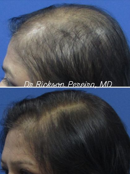 Another angle showcasing the successful regrowth in a case of advanced female pattern hair loss. My approach focuses on using proven treatments and ensuring the patient follows the protocol consistently for the best outcome.