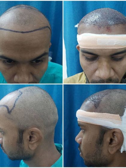 A four-panel image showing the patient from different angles before and immediately after the hair transplant, illustrating the comprehensive work done.