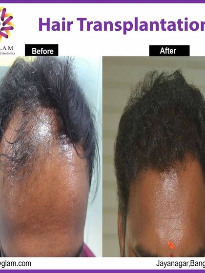 We successfully addressed this client's receding hairline and frontal thinning. The hair transplant resulted in a significantly lower and denser hairline, framing the face effectively.