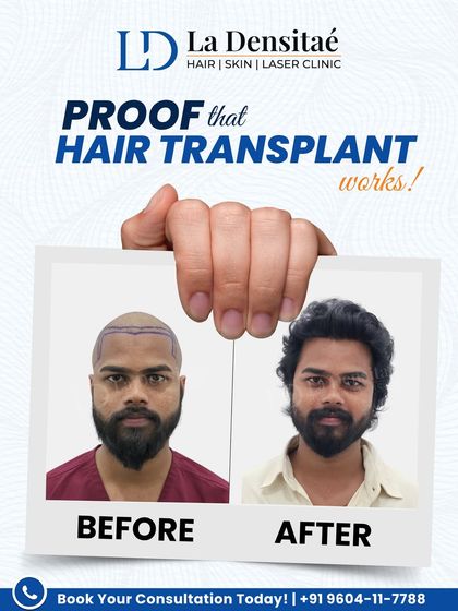 Prince Yuvraj Sen’s transformation is another example of a natural result. My advanced RT-FUE hair transplant technique delivers outcomes so seamless that people can’t even tell it’s a transplant. It’s not just about restoring hair, it’s about restoring you.