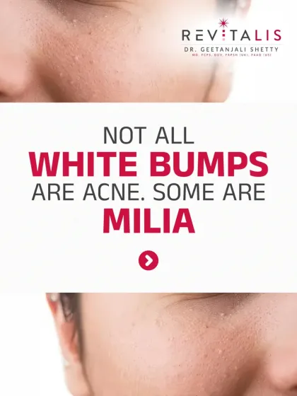 Identifying Milia: The Bumps That Aren't Acne. Those tiny white bumps, especially around the eyes, are often milia, not whiteheads. This post explains what they are (trapped keratin) and why you can't pop them.