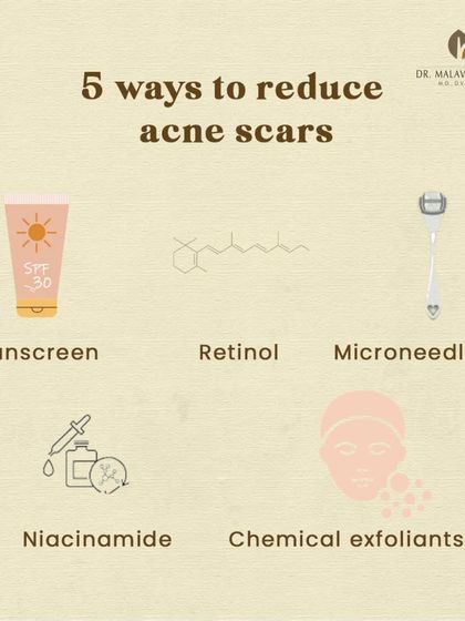 A multi-faceted approach is required to effectively reduce the appearance of acne scars. This infographic outlines five key strategies, from daily habits like sunscreen application to clinical treatments like microneedling, that work synergistically to improve skin texture and tone.