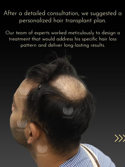 After a detailed consultation with Aman, we identified his specific hair loss pattern. Our team then designed a personalized hair transplant plan to address the balding on his crown and deliver long-lasting, natural results.