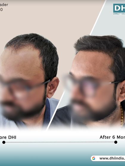 A side-profile before and after of a 29-year-old client, 6 months post-procedure. After implanting 5,443 hairs, his hairline is restored and his hair appears significantly thicker and healthier.