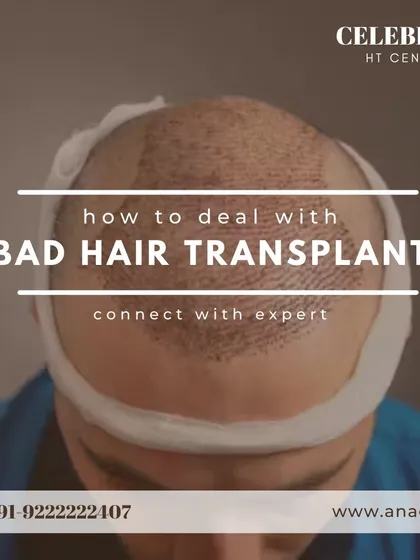 Thinking about a hair transplant? Not all results are the same. This image warns against bad hair transplants and emphasizes the importance of research and choosing a qualified expert.
