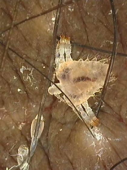 This is a highly magnified image of a pubic louse, or crab louse, clutching a hair shaft alongside its eggs, known as nits. Using a dermatoscope allows for this level of detail, which is crucial for identifying the parasite and confirming the diagnosis of this particular STI.