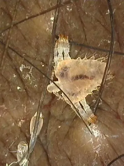 This is a highly magnified image of a pubic louse, or crab louse, clutching a hair shaft alongside its eggs, known as nits. Using a dermatoscope allows for this level of detail, which is crucial for identifying the parasite and confirming the diagnosis of this particular STI.