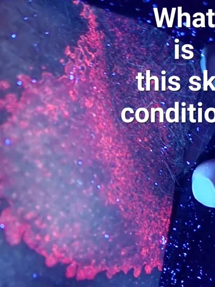 This image shows a skin condition glowing coral-red under a Wood's lamp, which is a key diagnostic sign of Erythrasma, a bacterial infection. It is a great example of why proper diagnosis is crucial, as this is often mistaken for a fungal infection.