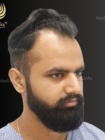 A side view showing the patient ready for his hair restoration. Our results speak for themselves, and it all starts with careful planning and a deep understanding of each patient's goals.