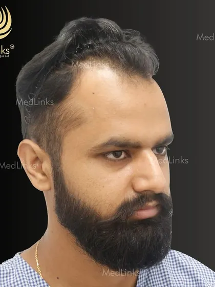 A side view showing the patient ready for his hair restoration. Our results speak for themselves, and it all starts with careful planning and a deep understanding of each patient's goals.