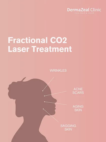 The Fractional CO2 laser is a versatile treatment that addresses not just acne scars, but also wrinkles, aging skin, and sagging skin by promoting deep collagen remodeling.
