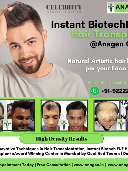 This collage of before and after photos demonstrates the high density results we achieve with our innovative Instant Biotech FUE hair transplant technique.