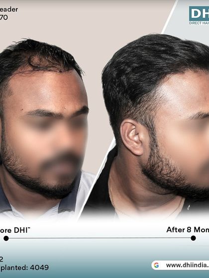 A before and after of a 32-year-old client 8 months after receiving 4,049 implanted hairs. The transformation is remarkable, with a restored hairline and excellent density.