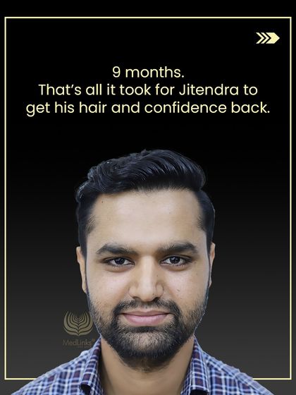 Just 9 months later, Jitendra has his hair and his confidence back. This is the power of expert planning and advanced techniques.