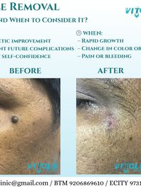 Dermatosurgery (Minor Procedures)