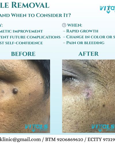 Dermatosurgery (Minor Procedures)