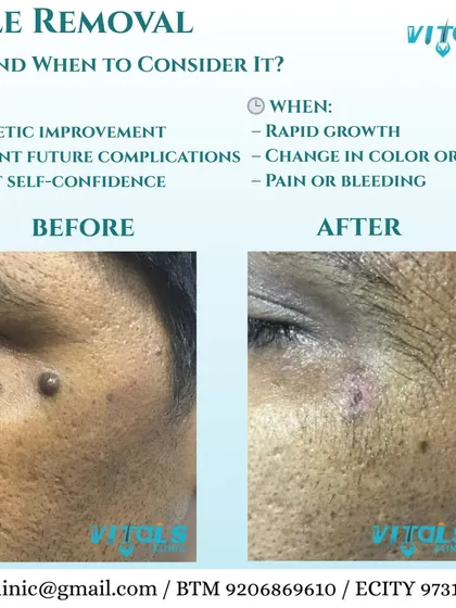 This before-and-after image shows the result of a facial mole removal. I perform this procedure for both cosmetic improvement and to address any medical concerns, ensuring minimal scarring and a smooth outcome.