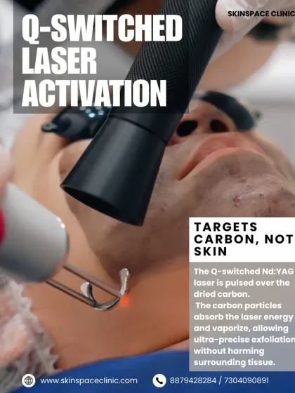 This visual explains the mechanism of the Q-switched laser used in a Carbon Peel. The laser is pulsed over the dried carbon, which absorbs the energy and vaporizes. This allows for ultra-precise exfoliation without harming the surrounding skin tissue.