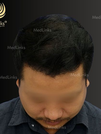 The top-down view after the transplant, demonstrating the excellent coverage.