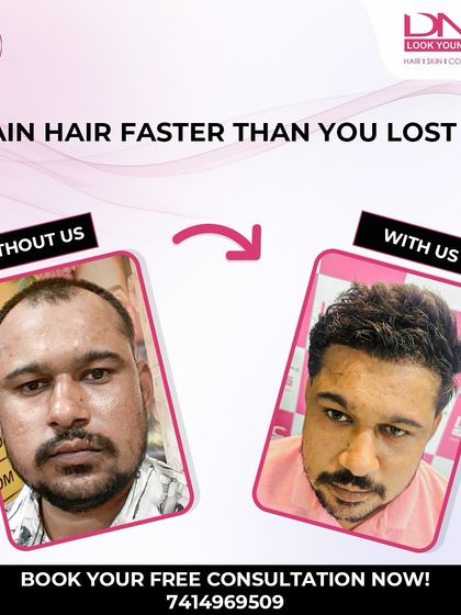 You can gain hair faster than you lost it. This side-by-side comparison is a powerful example of how my hair restoration services can turn back the clock on hair loss and bring back your confidence.