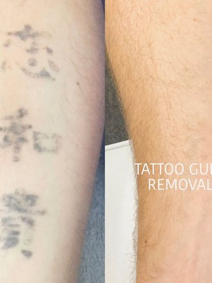 An example of an older tattoo with faded characters being cleared from an arm. Even aged tattoos can be effectively removed.