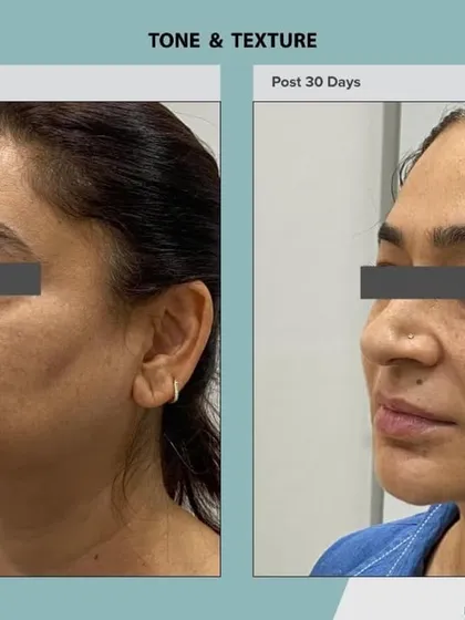 A side profile view highlighting the textural improvements and evening of skin tone achieved with the AdvaTx laser. The treatment effectively addresses sun damage and signs of aging.