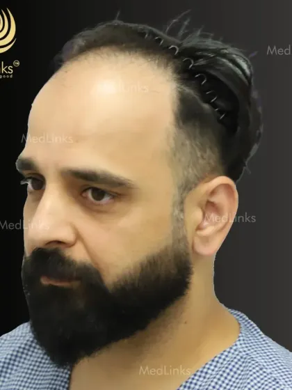 A profile view of the same patient, ready for his transformation. Our techniques ensure that the new hair will blend seamlessly with his existing hair for a completely natural result.