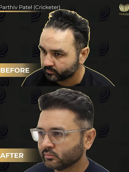 This three-quarter view of Parthiv Patel's before and after highlights the artistry involved in creating a hairline that perfectly frames the face.