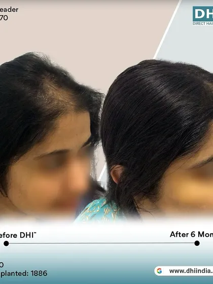 A side-profile view of a 30-year-old female client 6 months after her no-shave hair transplant. We implanted 1,886 hairs to restore her hairline, achieving a natural and beautiful result.