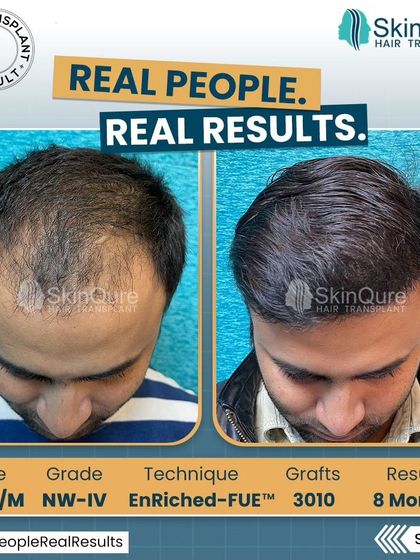 An 8-month follow-up for a 28-year-old patient with Norwood Grade IV hair loss. We used 3010 grafts to reconstruct his hairline and add density throughout the top. The result is a natural, dense look that has restored his confidence.