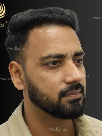 The final result from the side, with a natural and well-defined hairline.