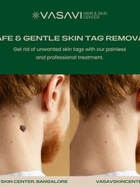 Wart, Skin Tag & Keloid Removal