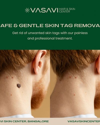 Wart, Skin Tag & Keloid Removal