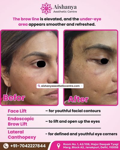 Facial Cosmetic Surgery