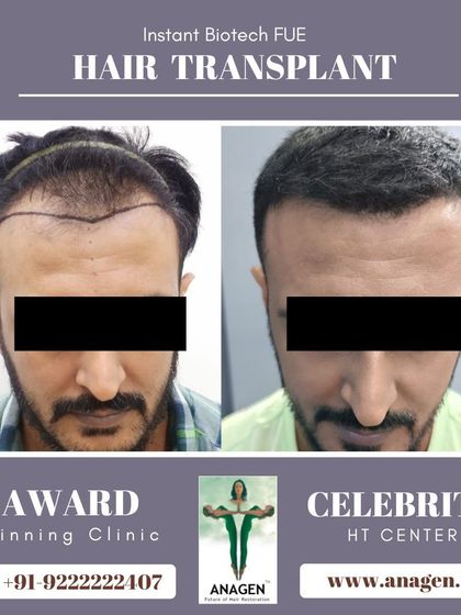 A great before and after result from our Instant Biotech FUE hair transplant. The patient's new hairline is natural and well defined.