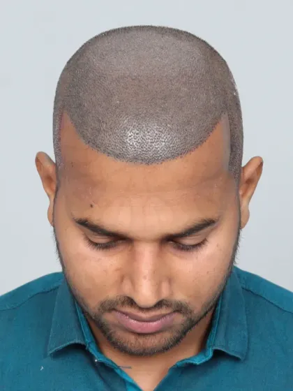 From Grade 5A baldness to bold confidence in just 7 months. This patient received 5850 grafts for a dense, natural-looking hairline.