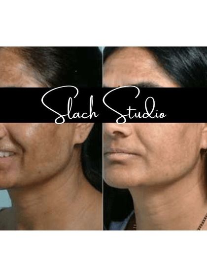 This before-and-after shows a significant improvement in skin tone and texture, reducing hyperpigmentation for a clearer look.