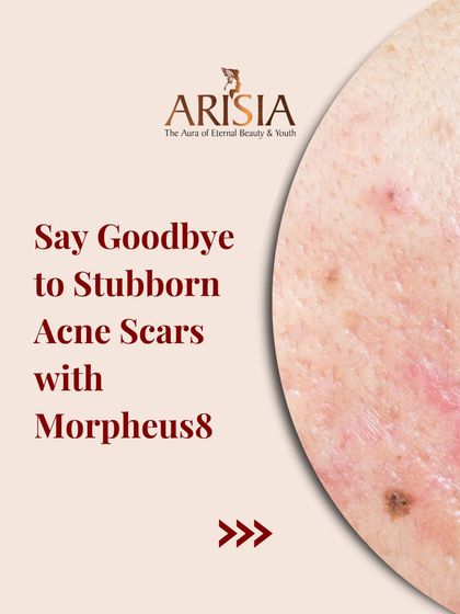 Morpheus8 is my go-to for stubborn acne scars. This advanced treatment effectively resurfaces the skin for a smoother, more refined complexion.
